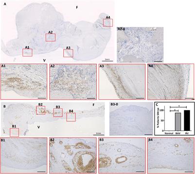 Atypical Expression of Smooth Muscle Markers and Co-activators and Their Regulation in Rheumatic Aortic and Calcified Bicuspid Valves